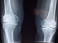 Lateral Sole Wedges - how symptoms of medial knee osteoarthritis are improved